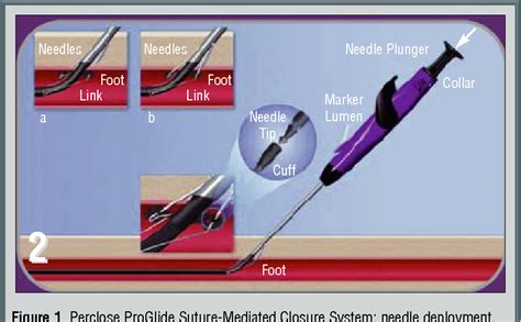 Figure 1 from Complications of femoral artery access during cardiac ...