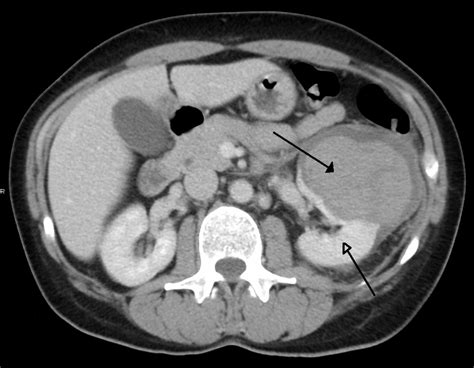 Retroperitoneal Hematoma: The Forgotten Space