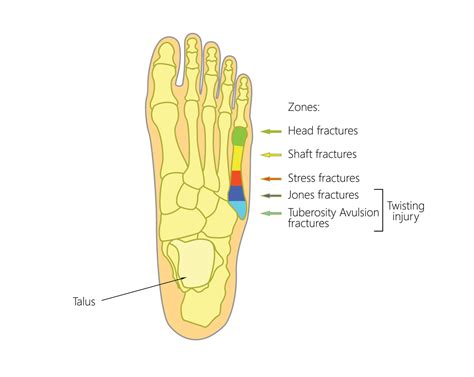 What are Fifth Metatarsal Fractures? | Strash Foot & Ankle Care