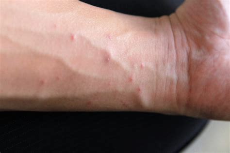 Scabies - Signs, Symptoms, OTC Treatment & Home Remedies