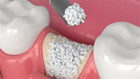 How Much Is Dental Bone Graft Cost? It's 0! | Full Mouth Dental Implants