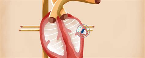 Watchman procedure reduces stroke risk in AFib patients