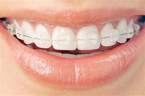 How Six Month Smiles Accelerated Braces Work | River Vista Dentistry