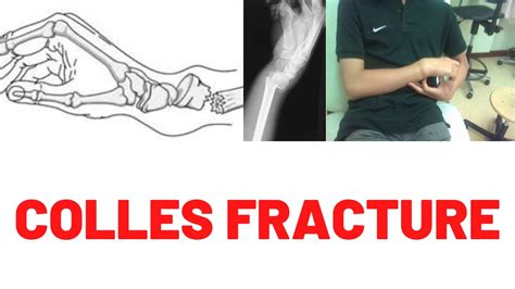 Colles fracture vs smith fracture x ray - nibhtbus