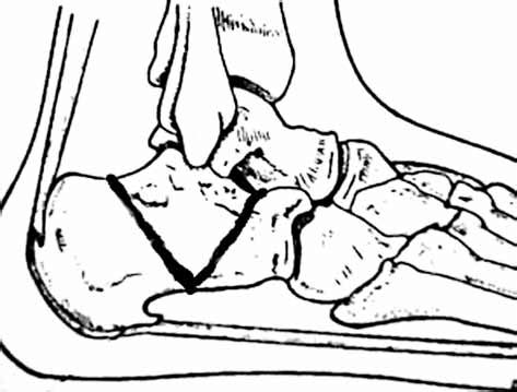 -Schematic drawing of osteotomy end at the subtalar joint. | Download ...