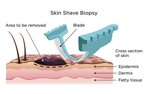 Skin Biopsy | My Doctor Online