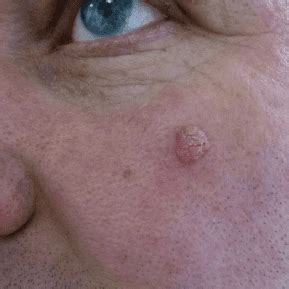 Seborrhoeic Wart Removal Testimonials - Leeds, Bradford, Yorkshire