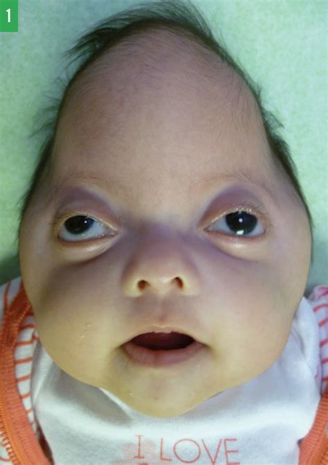 Pfeiffer Syndrome Type 2: Cloverleaf-Shaped Skull in a Newborn ...