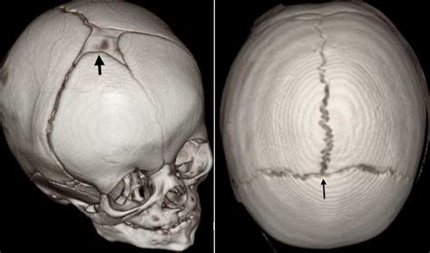 Anterior fontanelle closure and diagnosis of non-syndromic ...