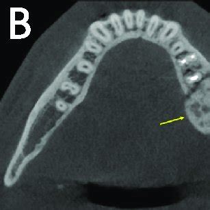 (A) Cementoblastoma. Panoramic radiograph of a periapical, sclerotic ...