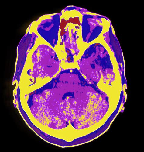 Coloured Ct Scan Of The Brain Showing A Stroke Photograph by Mehau ...