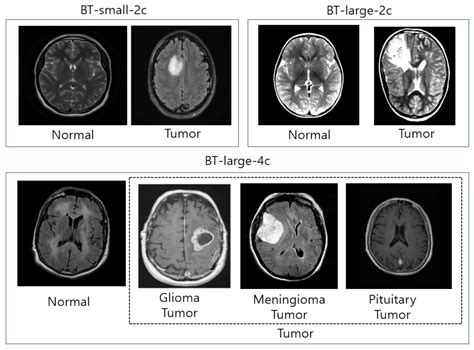 Brain Mri Tumor