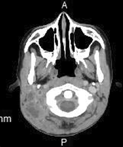 Internal jugular vein thrombosis | Download Scientific Diagram