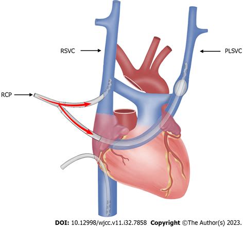 Persistent left superior vena cava in right hemiarch replacement under ...