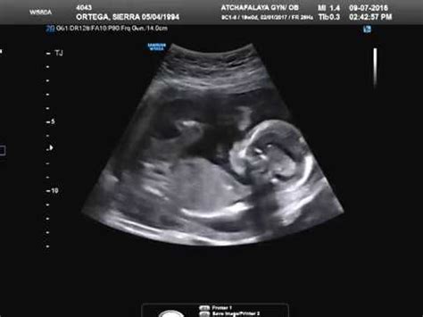 Baby girl's ultrasound at 19 weeks - YouTube