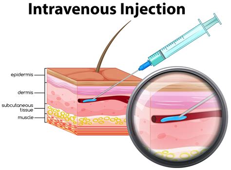 Intravenous injection on white background 433616 Vector Art at Vecteezy