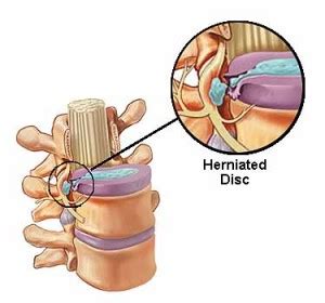 A Slipped Disc...Do Surgery - Medical Articles by Dr. Ray