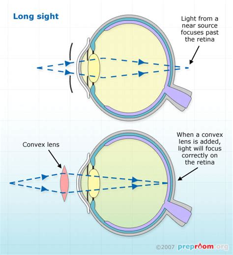 how do glasses work for long sightedness - Jefferey Lear