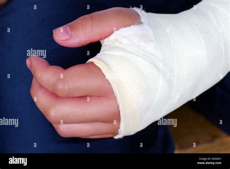 Broken hand with plaster cast close up Stock Photo - Alamy