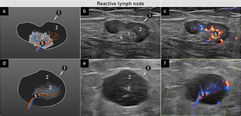 Groin Lymph Nodes Ultrasound