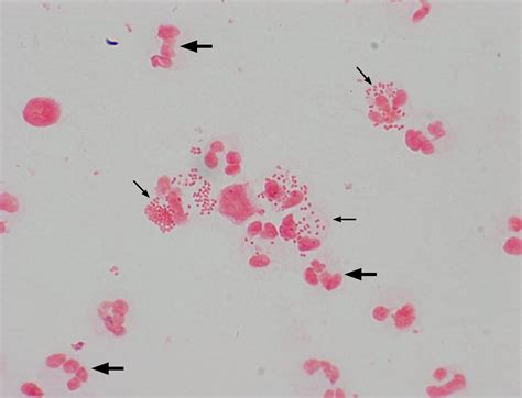 Neisseria gonorrhoeae present in a Gram stain of a patient with ...