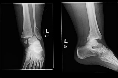 OrthoDx: Ankle Fracture in Patient With Diabetes - Clinical Advisor