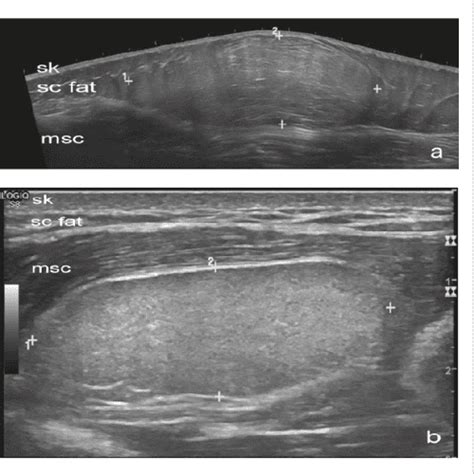 [PDF] Ultrasound for diagnosis of soft-tissue lipoma : accuracy and ...