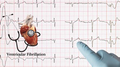 Ventricular Fibrillation (Vfib treatment) - Meaning, Types, Symptoms ...