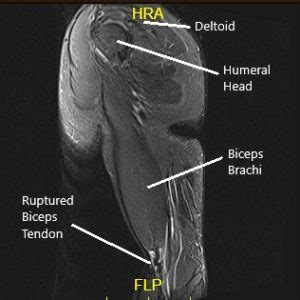 Icd 10 Code For Left Bicep Tendon Rupture