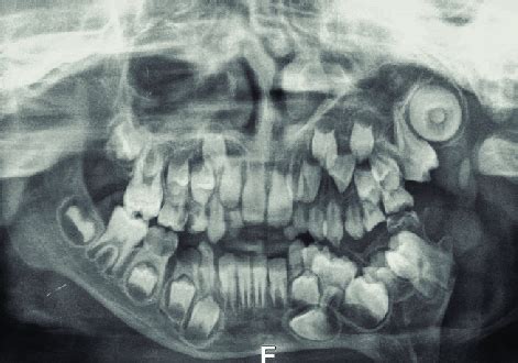 Orthopantomograph. Normal development of the mixed dentition on the ...