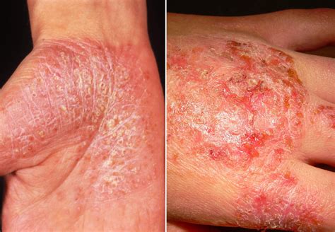 Systematic Review of Eczema in Plaque Psoriasis Treated With Biologic ...