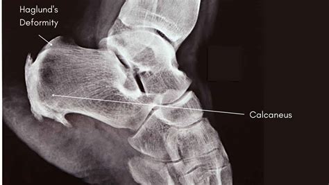 Retrocalcaneal Bursitis X Ray