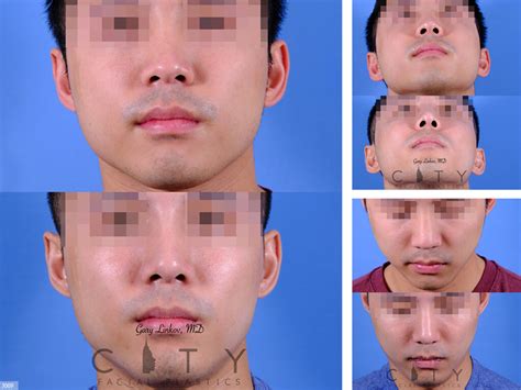 NYC Nasal Surgery (Rhinoplasty) Before and After Pictures - New York - UES