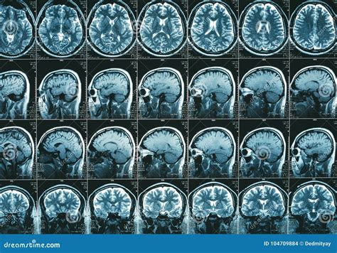 MRI Brain Scan or Magnetic Resonance of Head Image Results Editorial ...