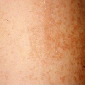 Maculopapular Rash | Picturtes, Causes, Symptoms, Diagnosis & Treatment