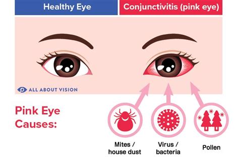 Conjunctivitis Pink Eye Symptoms Causes Treatment