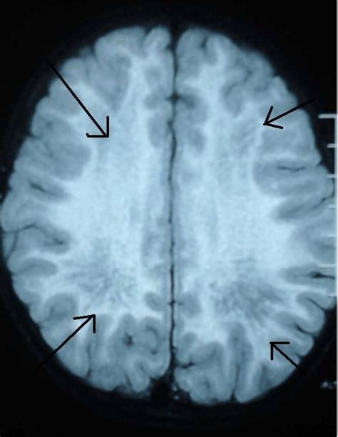 Metachromatic leukodystrophy | Poland| PDF | PPT| Case Reports ...