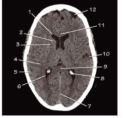 Head CT anatomy | Radiology Key