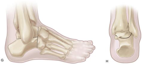 33 Triple Arthrodesis | Musculoskeletal Key