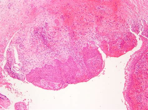 Eruption Cyst Histology