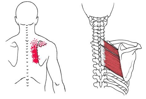 Rhomboid Muscle Pain | How To Fix Pain In Shoulder Blade