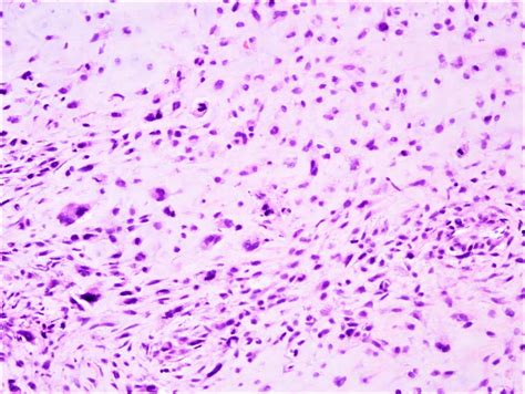 Chondrosarcoma Histology