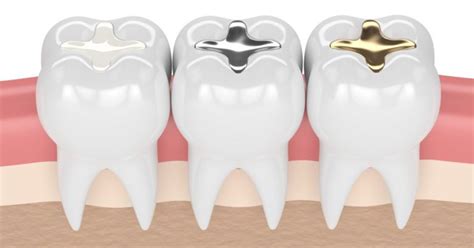 Comparing Filling Materials for Dental Fillings » Dentists In Rock Hill ...