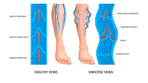 Causes of Venous Ulcers and How to Prevent Them?