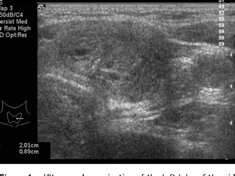 Figure 1 from A case of Riedel's thyroiditis associated with benign ...