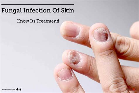 Fungal Infection Of Skin - Know Its Treatment! - By Dr. Malini Patil ...