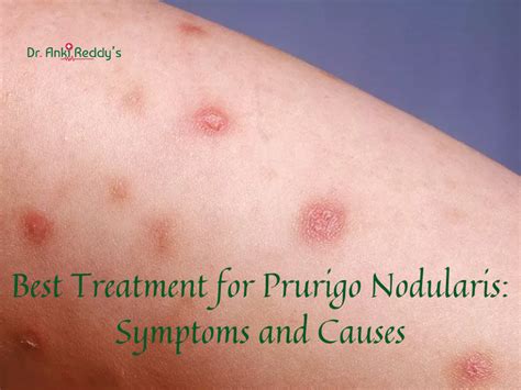 Best Treatment for Prurigo Nodularis: Symptoms and Causes