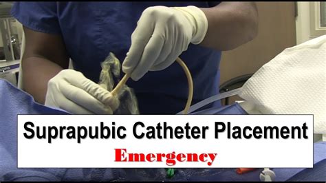 Suprapubic Catheter Infection