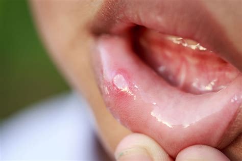 Oral Thrush - Symptoms, Causes, Treatments, and More