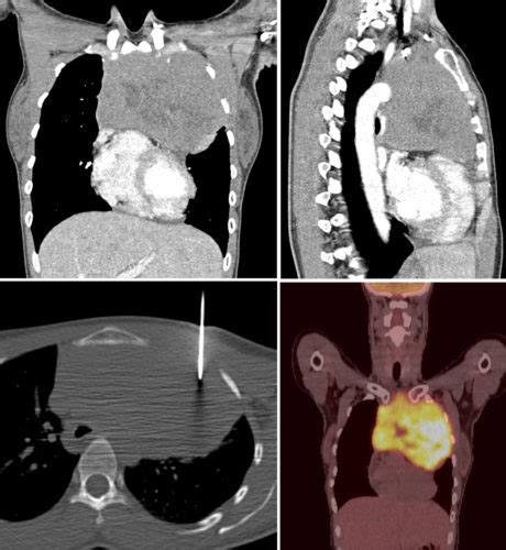 Anterior mediastinal mass - Radiology at St. Vincent's University Hospital